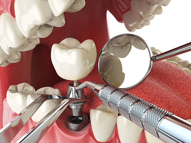 Best Emergency Root Canal Therapy in Monmouth, IL